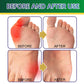 8pcs/box Anti Bunion Patch Finger Toe Bunion Pain Relief  Bunion Corrector Foot Bone Thumb Corrector Stickers Foot Care Tools