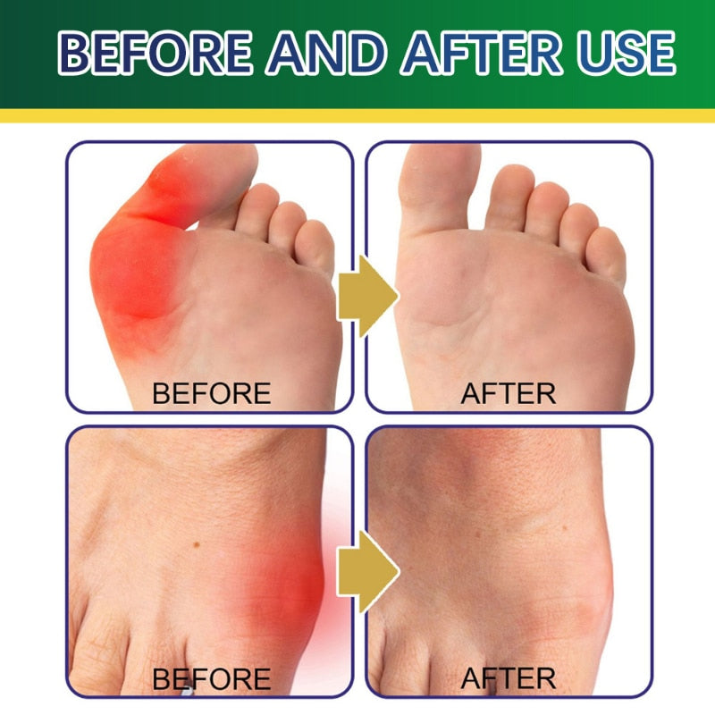 8pcs/box Anti Bunion Patch Finger Toe Bunion Pain Relief  Bunion Corrector Foot Bone Thumb Corrector Stickers Foot Care Tools
